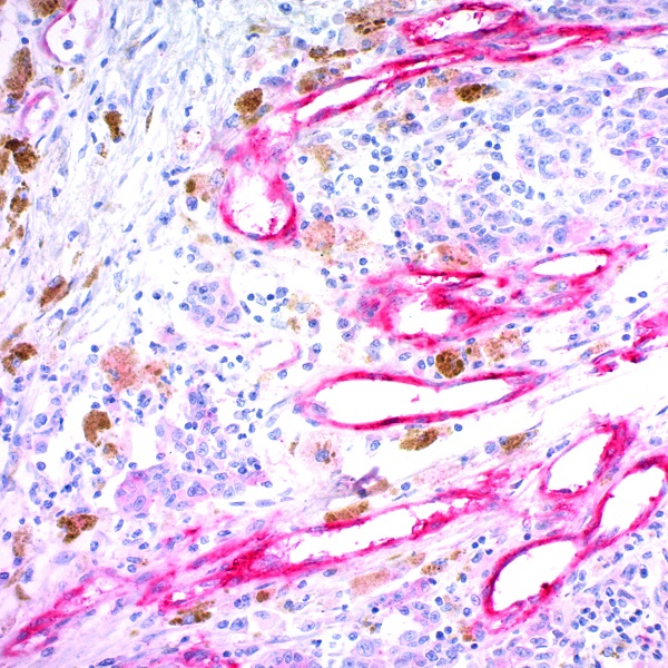 Melanoma Associated Antigen; Clone KBA.62 (Ready-To-Use)